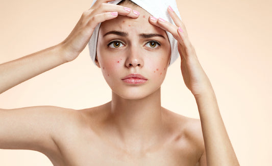 GUIA PRACTICA DE 10 PASOS PARA MEJORAR EL ACNE