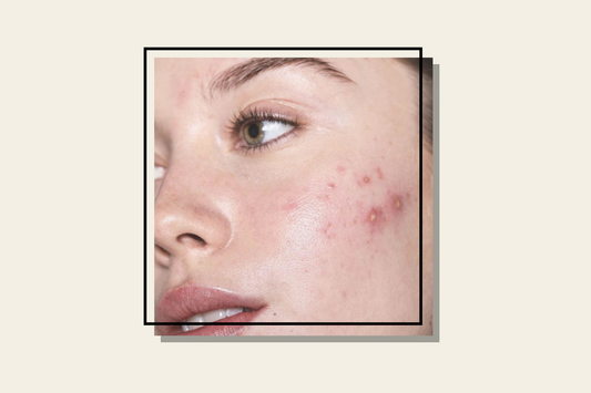 LOS ACEITES Y SU MAGNIFICA RELACION CON EL ACNE